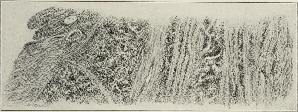 An illustration from A text-book of pathology / by Alfred Stengel ; with 394 illustrations in the text, many of them in colors, and 7 full-page chromolithographic plates., 1903, leaf 553