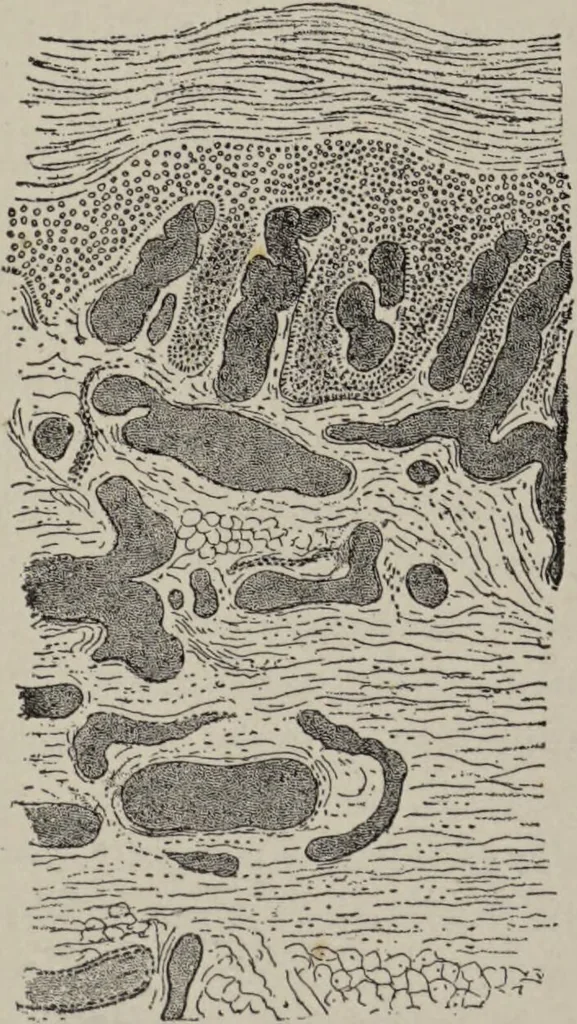 An illustration from A text-book of pathology / by Alfred Stengel ; with 394 illustrations in the text, many of them in colors, and 7 full-page chromolithographic plates., 1903, leaf 56