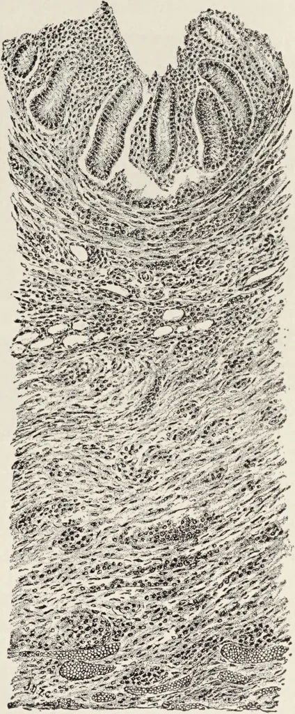 An illustration from A text-book of pathology / by Alfred Stengel ; with 394 illustrations in the text, many of them in colors, and 7 full-page chromolithographic plates., 1903, leaf 567