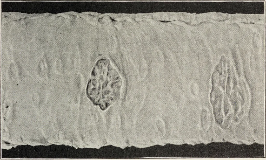 An illustration from A text-book of pathology / by Alfred Stengel ; with 394 illustrations in the text, many of them in colors, and 7 full-page chromolithographic plates., 1903, leaf 573