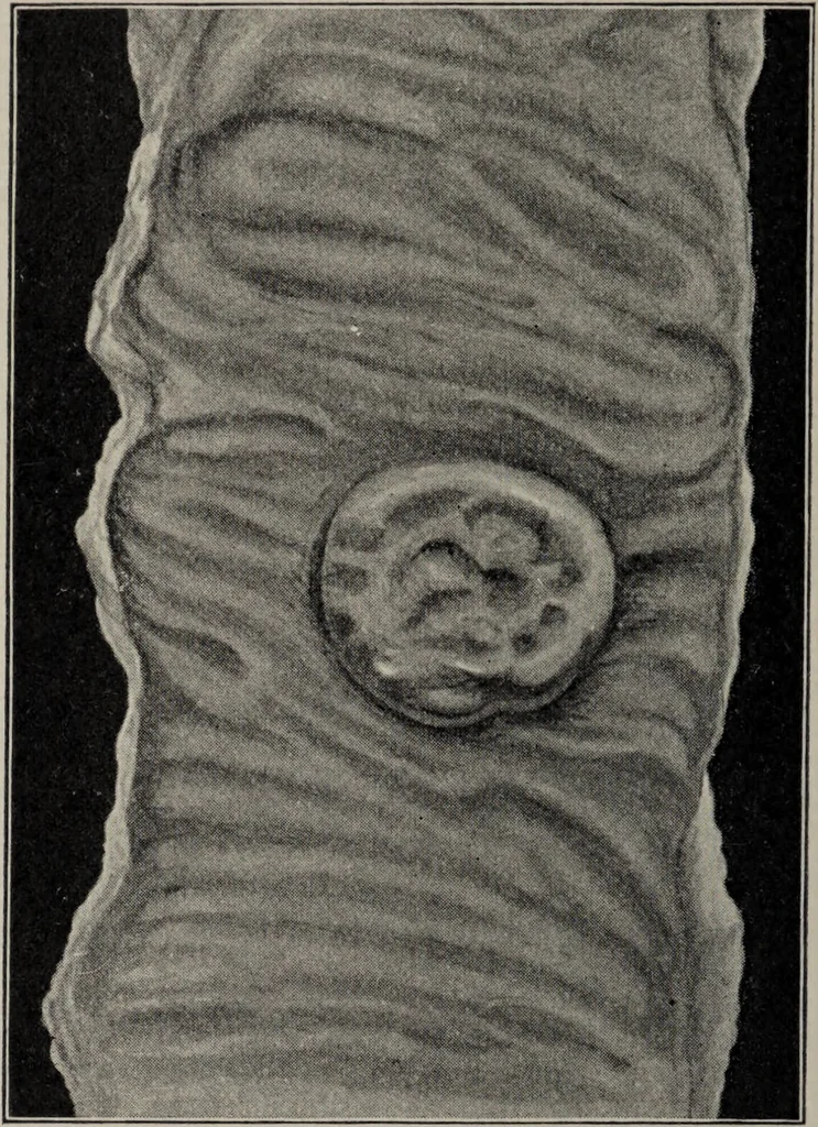 An illustration from A text-book of pathology / by Alfred Stengel ; with 394 illustrations in the text, many of them in colors, and 7 full-page chromolithographic plates., 1903, leaf 576