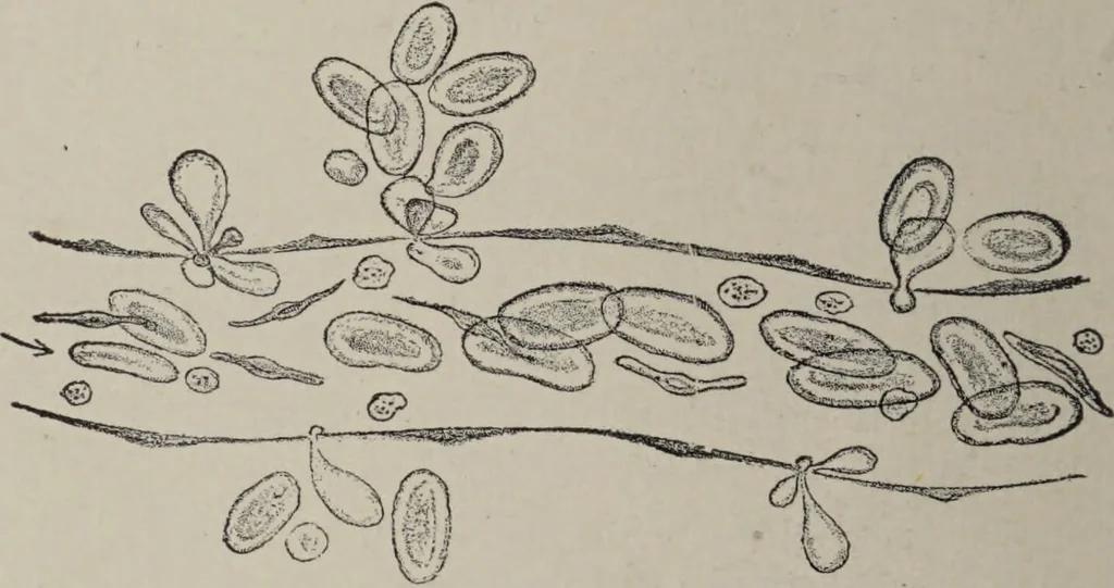 An illustration from A text-book of pathology / by Alfred Stengel ; with 394 illustrations in the text, many of them in colors, and 7 full-page chromolithographic plates., 1903, leaf 58