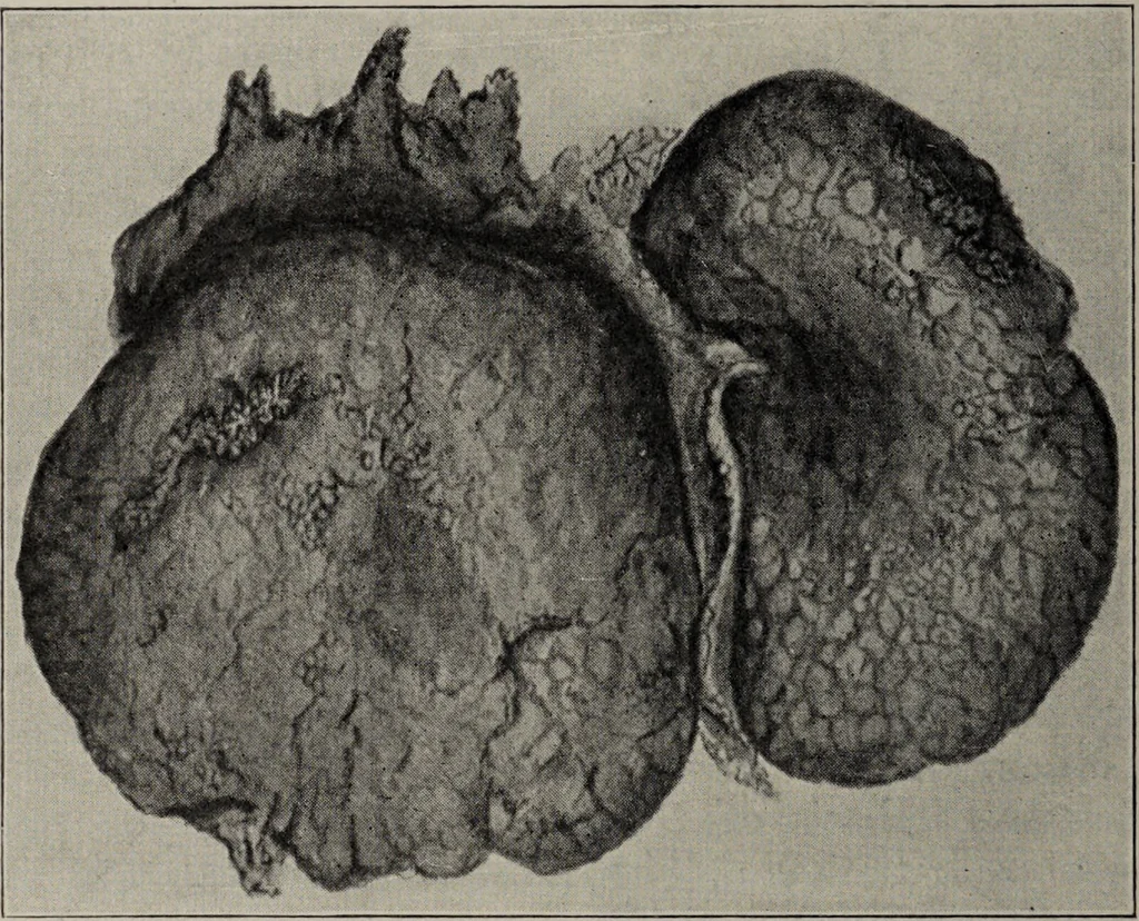 An illustration from A text-book of pathology / by Alfred Stengel ; with 394 illustrations in the text, many of them in colors, and 7 full-page chromolithographic plates., 1903, leaf 590