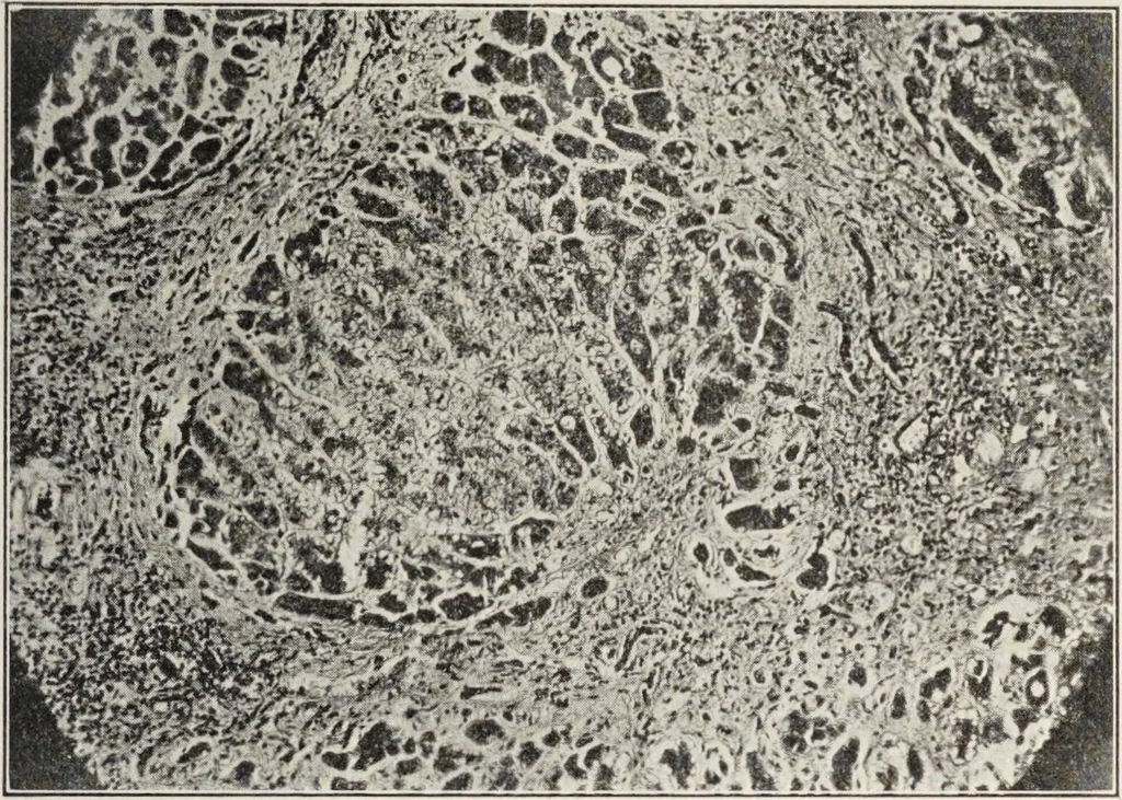 An illustration from A text-book of pathology / by Alfred Stengel ; with 394 illustrations in the text, many of them in colors, and 7 full-page chromolithographic plates., 1903, leaf 591