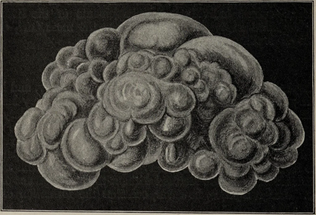An illustration from A text-book of pathology / by Alfred Stengel ; with 394 illustrations in the text, many of them in colors, and 7 full-page chromolithographic plates., 1903, leaf 594