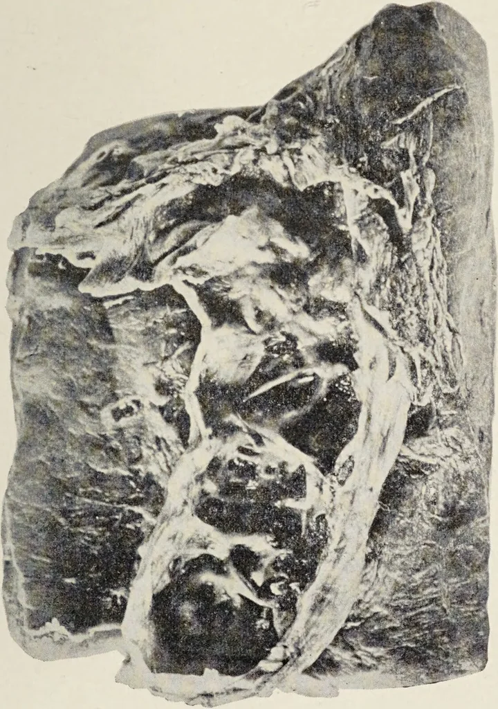 An illustration from A text-book of pathology / by Alfred Stengel ; with 394 illustrations in the text, many of them in colors, and 7 full-page chromolithographic plates., 1903, leaf 603
