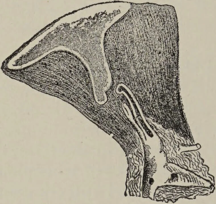 An illustration from A text-book of pathology / by Alfred Stengel ; with 394 illustrations in the text, many of them in colors, and 7 full-page chromolithographic plates., 1903, leaf 62