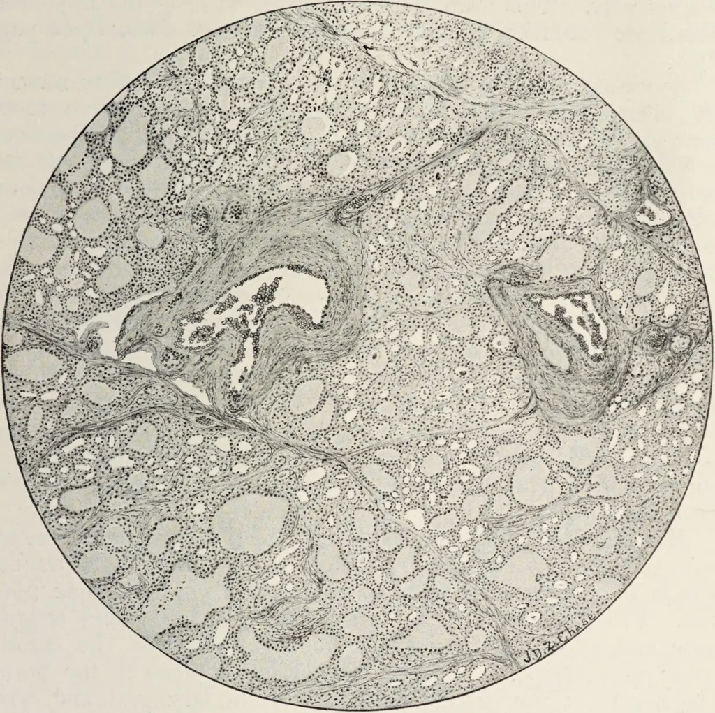 An illustration from A text-book of pathology / by Alfred Stengel ; with 394 illustrations in the text, many of them in colors, and 7 full-page chromolithographic plates., 1903, leaf 627