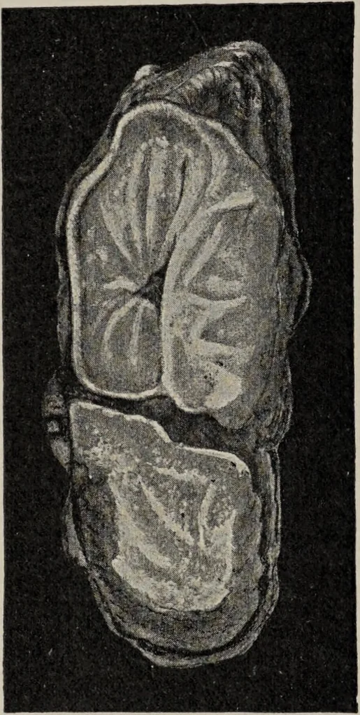 An illustration from A text-book of pathology / by Alfred Stengel ; with 394 illustrations in the text, many of them in colors, and 7 full-page chromolithographic plates., 1903, leaf 632
