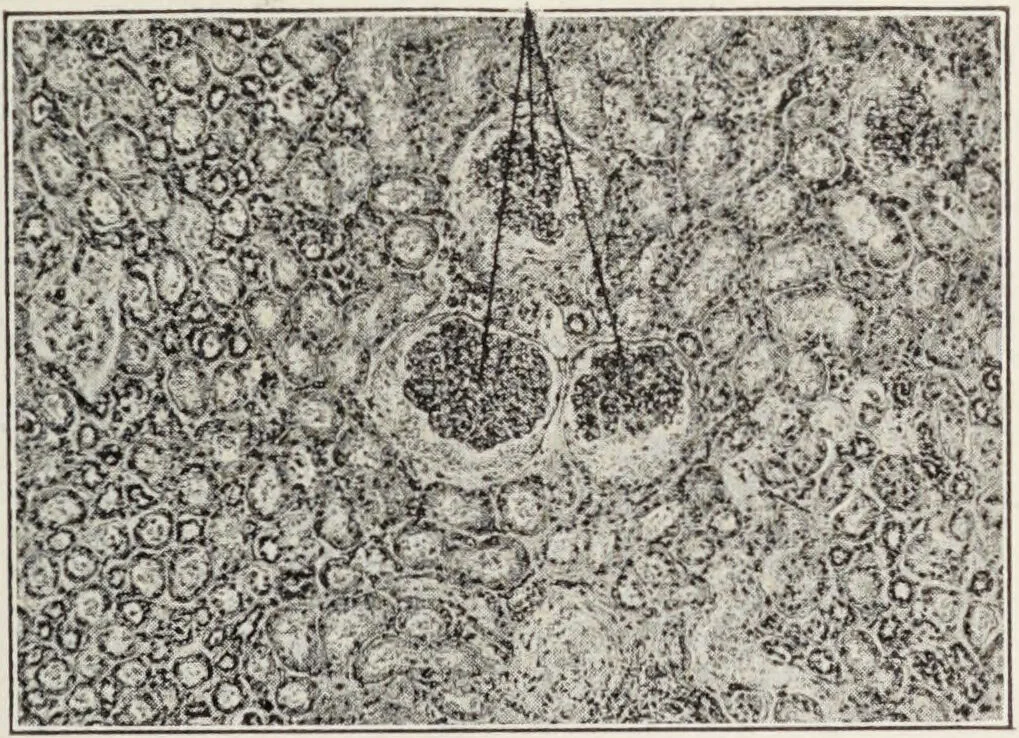 An illustration from A text-book of pathology / by Alfred Stengel ; with 394 illustrations in the text, many of them in colors, and 7 full-page chromolithographic plates., 1903, leaf 639
