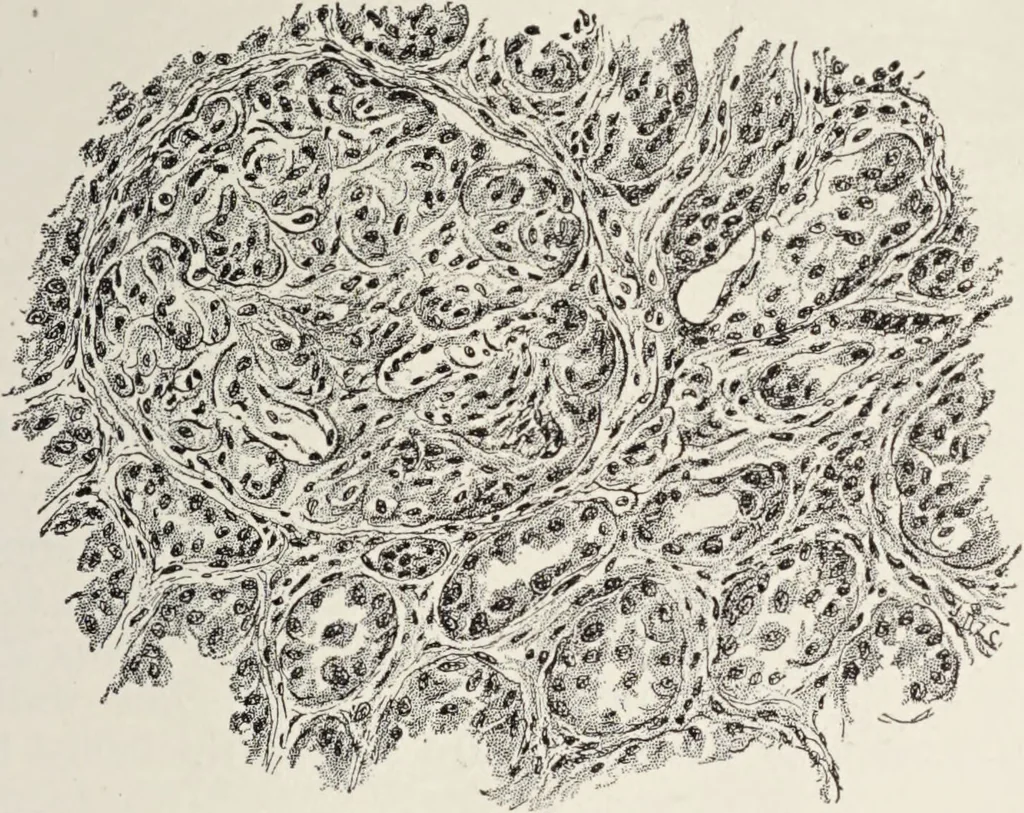 An illustration from A text-book of pathology / by Alfred Stengel ; with 394 illustrations in the text, many of them in colors, and 7 full-page chromolithographic plates., 1903, leaf 645