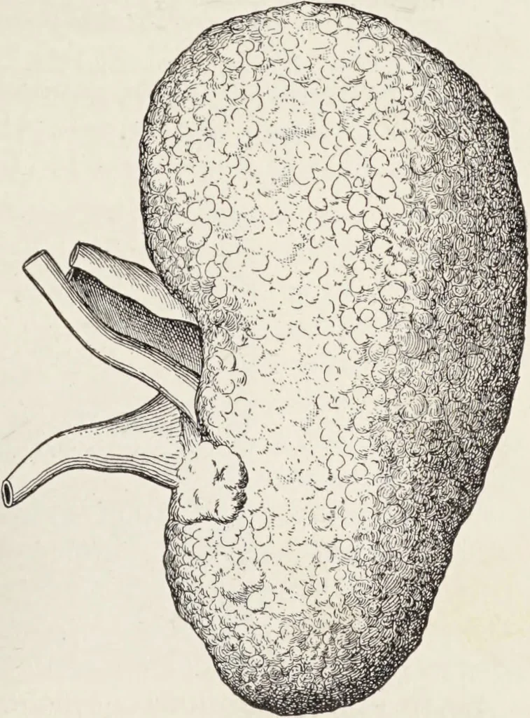 An illustration from A text-book of pathology / by Alfred Stengel ; with 394 illustrations in the text, many of them in colors, and 7 full-page chromolithographic plates., 1903, leaf 647