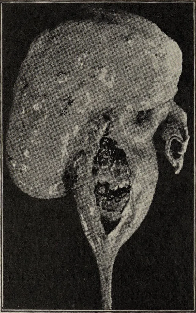An illustration from A text-book of pathology / by Alfred Stengel ; with 394 illustrations in the text, many of them in colors, and 7 full-page chromolithographic plates., 1903, leaf 666