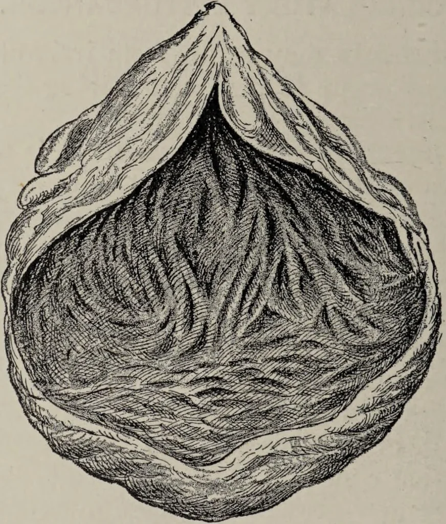 An illustration from A text-book of pathology / by Alfred Stengel ; with 394 illustrations in the text, many of them in colors, and 7 full-page chromolithographic plates., 1903, leaf 670