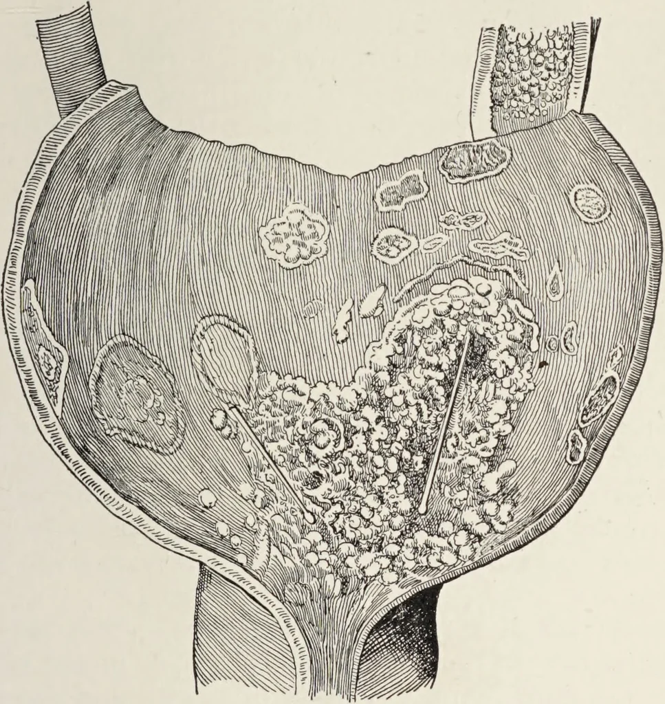 An illustration from A text-book of pathology / by Alfred Stengel ; with 394 illustrations in the text, many of them in colors, and 7 full-page chromolithographic plates., 1903, leaf 671