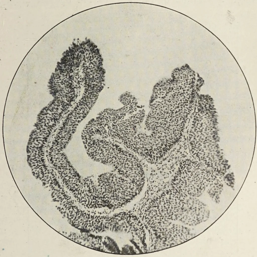 An illustration from A text-book of pathology / by Alfred Stengel ; with 394 illustrations in the text, many of them in colors, and 7 full-page chromolithographic plates., 1903, leaf 673