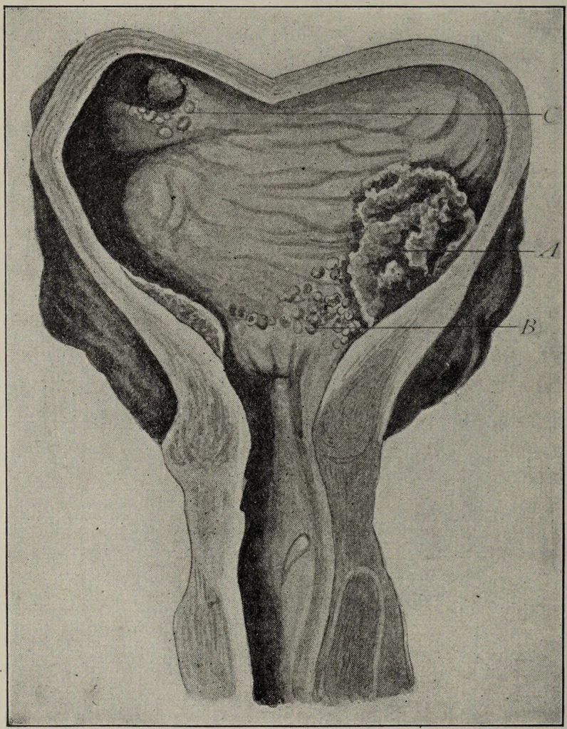 An illustration from A text-book of pathology / by Alfred Stengel ; with 394 illustrations in the text, many of them in colors, and 7 full-page chromolithographic plates., 1903, leaf 674