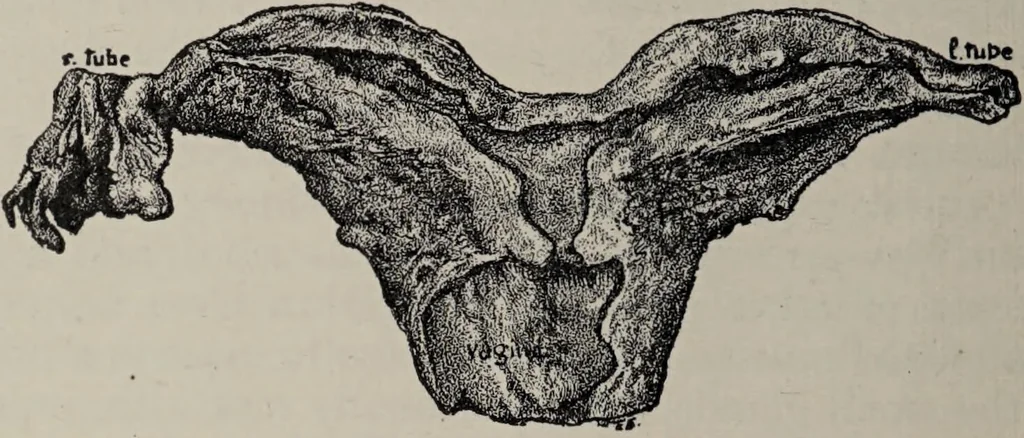 An illustration from A text-book of pathology / by Alfred Stengel ; with 394 illustrations in the text, many of them in colors, and 7 full-page chromolithographic plates., 1903, leaf 688