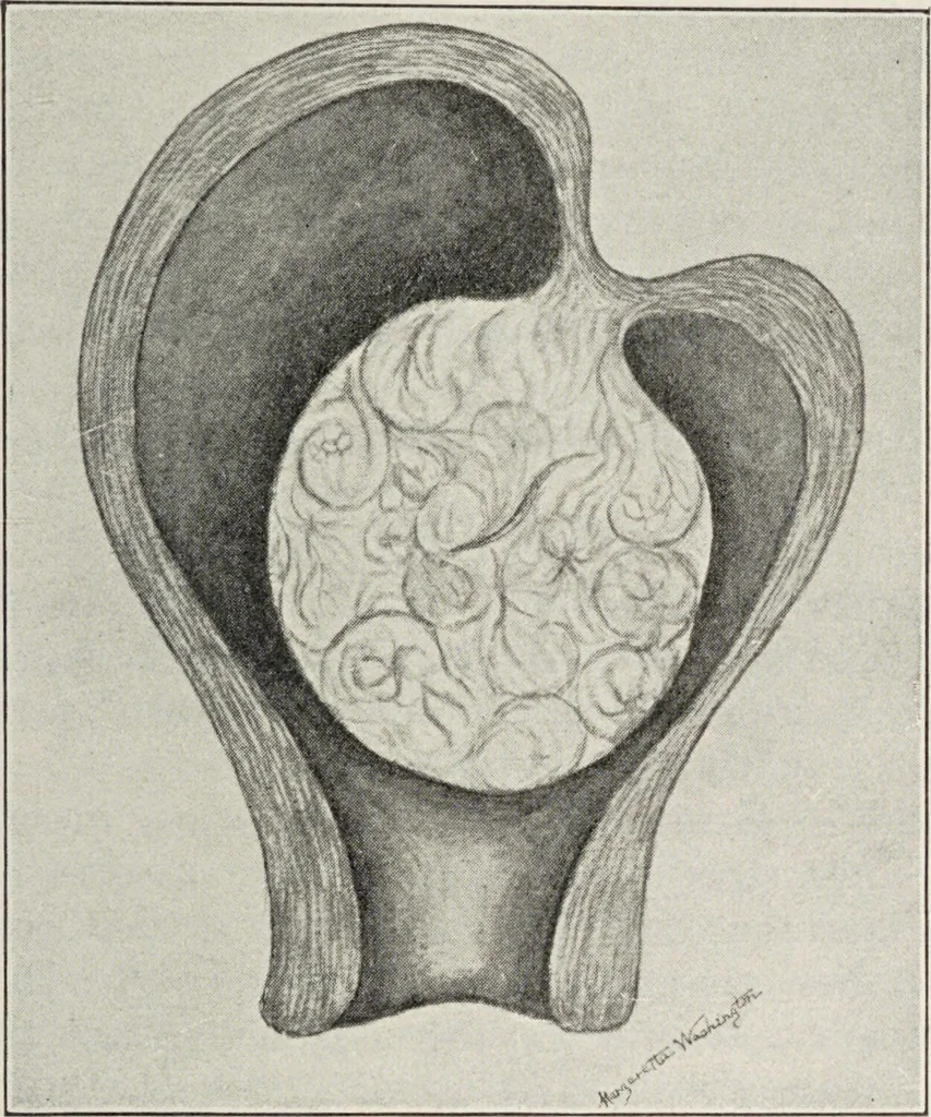 An illustration from A text-book of pathology / by Alfred Stengel ; with 394 illustrations in the text, many of them in colors, and 7 full-page chromolithographic plates., 1903, leaf 691