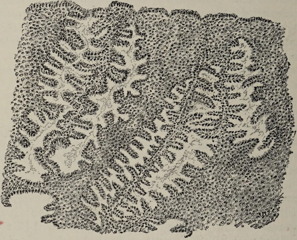 An illustration from A text-book of pathology / by Alfred Stengel ; with 394 illustrations in the text, many of them in colors, and 7 full-page chromolithographic plates., 1903, leaf 694