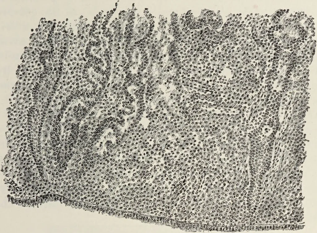 An illustration from A text-book of pathology / by Alfred Stengel ; with 394 illustrations in the text, many of them in colors, and 7 full-page chromolithographic plates., 1903, leaf 695