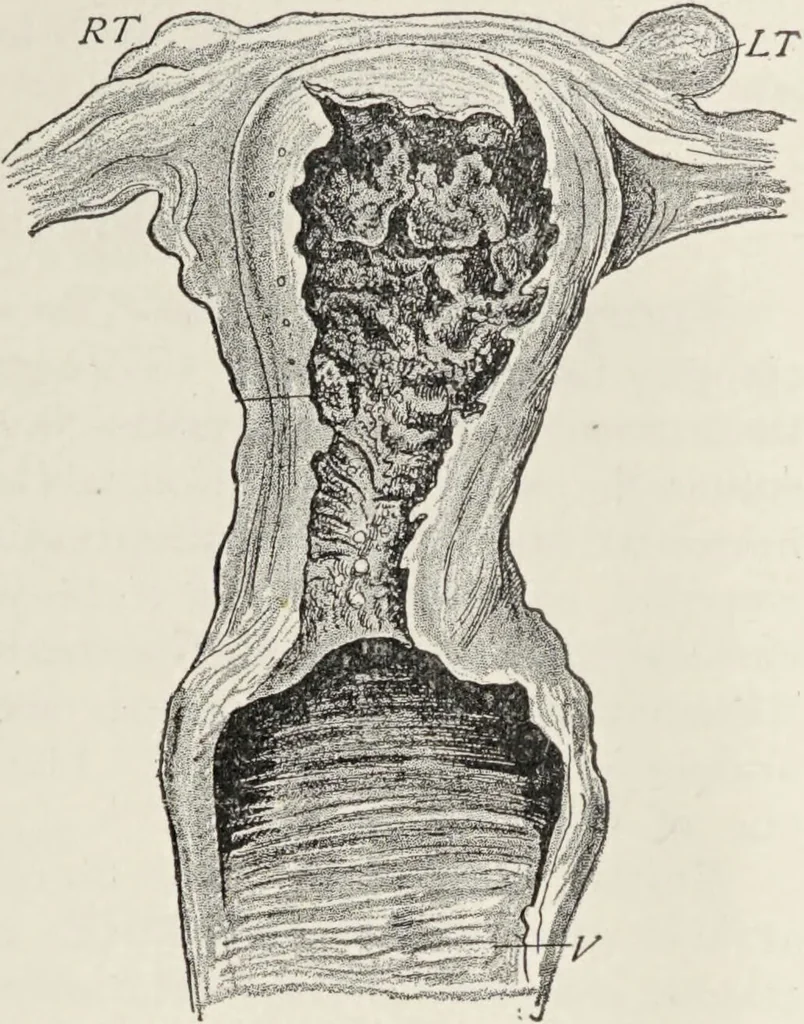 An illustration from A text-book of pathology / by Alfred Stengel ; with 394 illustrations in the text, many of them in colors, and 7 full-page chromolithographic plates., 1903, leaf 699