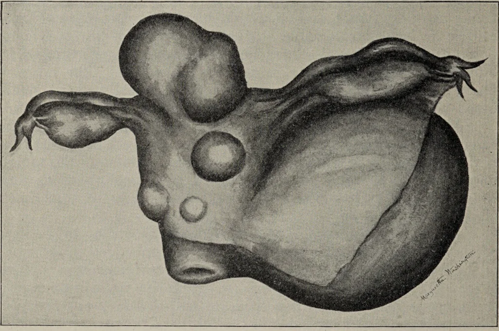 An illustration from A text-book of pathology / by Alfred Stengel ; with 394 illustrations in the text, many of them in colors, and 7 full-page chromolithographic plates., 1903, leaf 702