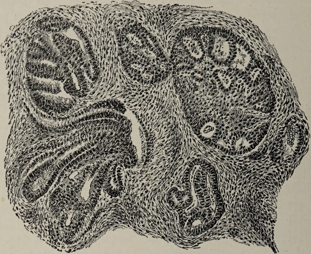 An illustration from A text-book of pathology / by Alfred Stengel ; with 394 illustrations in the text, many of them in colors, and 7 full-page chromolithographic plates., 1903, leaf 704