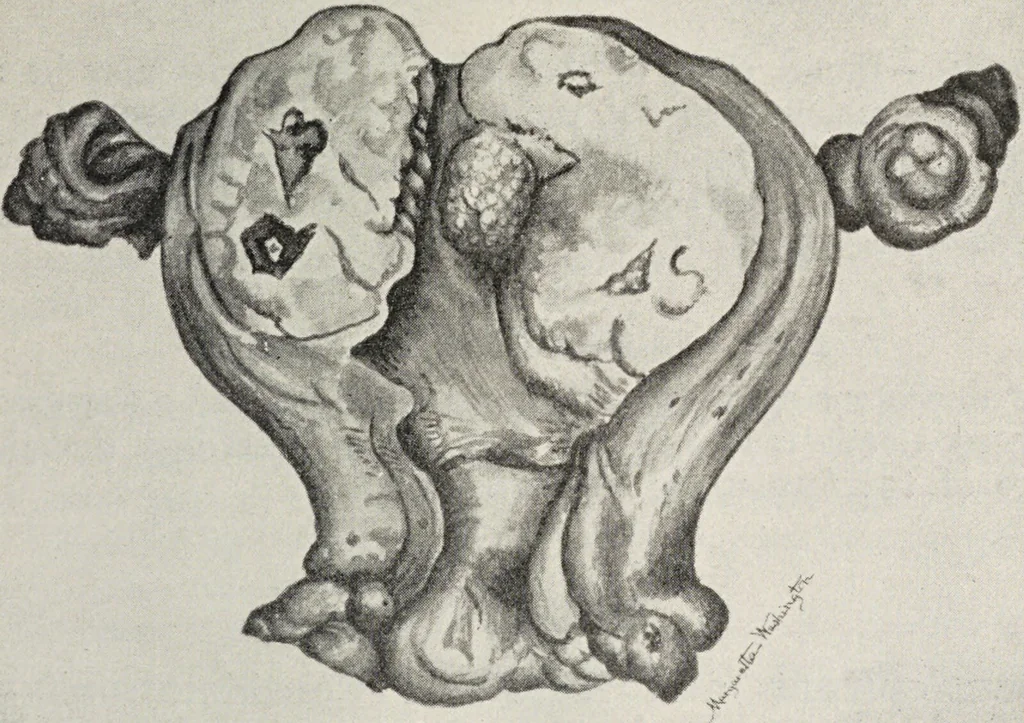 An illustration from A text-book of pathology / by Alfred Stengel ; with 394 illustrations in the text, many of them in colors, and 7 full-page chromolithographic plates., 1903, leaf 705