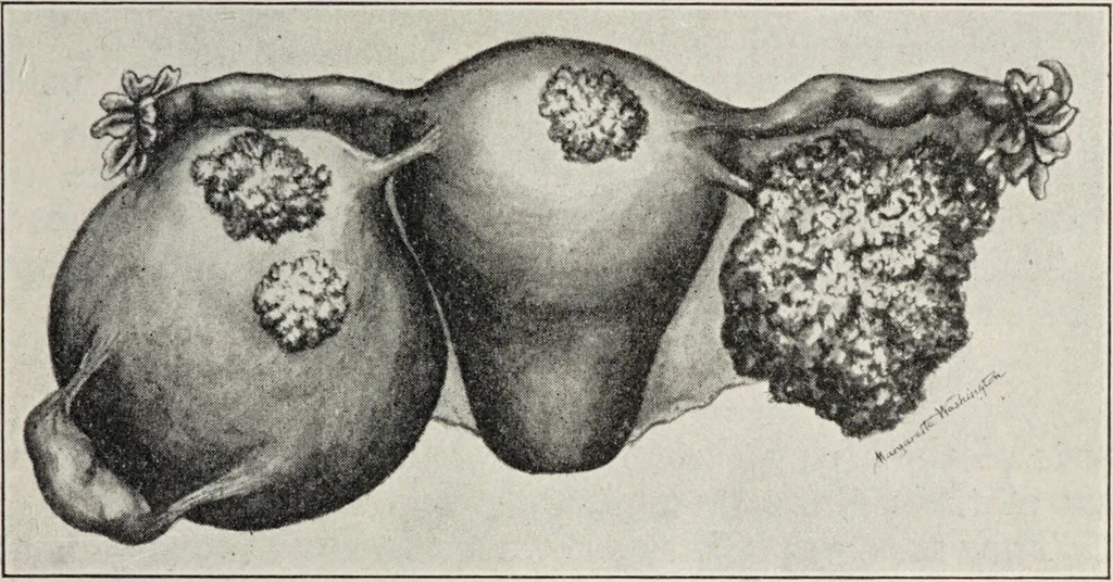 An illustration from A text-book of pathology / by Alfred Stengel ; with 394 illustrations in the text, many of them in colors, and 7 full-page chromolithographic plates., 1903, leaf 711