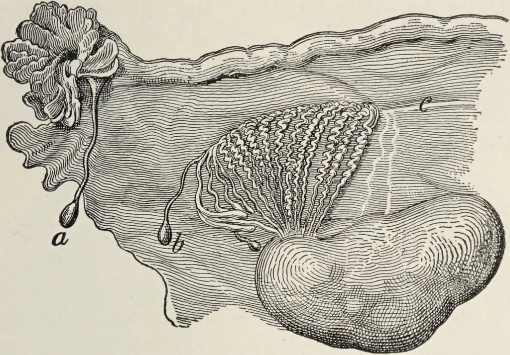 An illustration from A text-book of pathology / by Alfred Stengel ; with 394 illustrations in the text, many of them in colors, and 7 full-page chromolithographic plates., 1903, leaf 713
