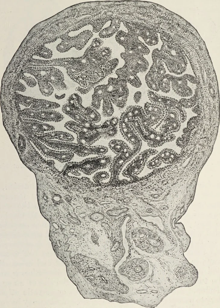 An illustration from A text-book of pathology / by Alfred Stengel ; with 394 illustrations in the text, many of them in colors, and 7 full-page chromolithographic plates., 1903, leaf 715