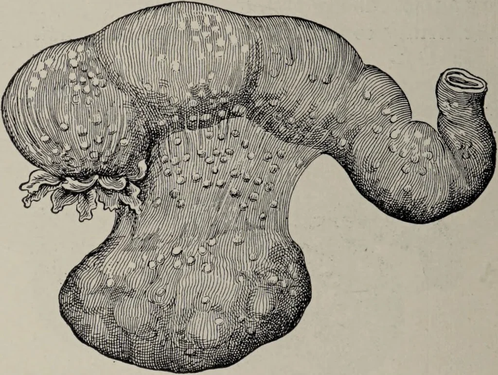 An illustration from A text-book of pathology / by Alfred Stengel ; with 394 illustrations in the text, many of them in colors, and 7 full-page chromolithographic plates., 1903, leaf 718