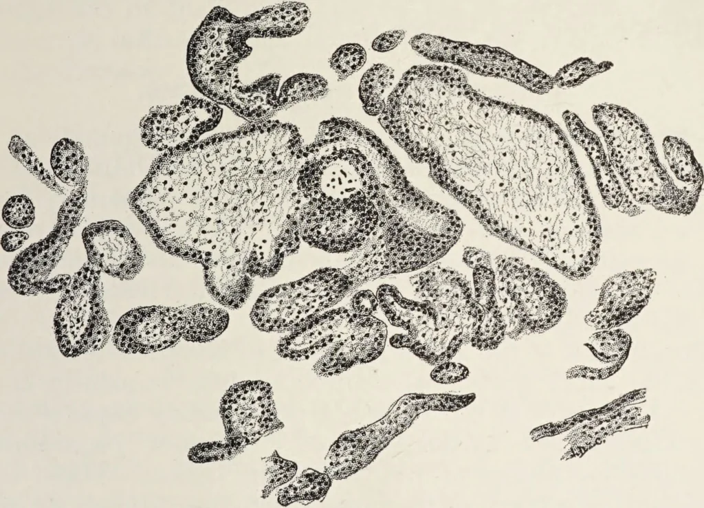 An illustration from A text-book of pathology / by Alfred Stengel ; with 394 illustrations in the text, many of them in colors, and 7 full-page chromolithographic plates., 1903, leaf 727