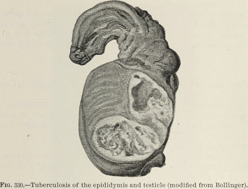 An illustration from A text-book of pathology / by Alfred Stengel ; with 394 illustrations in the text, many of them in colors, and 7 full-page chromolithographic plates., 1903, leaf 737