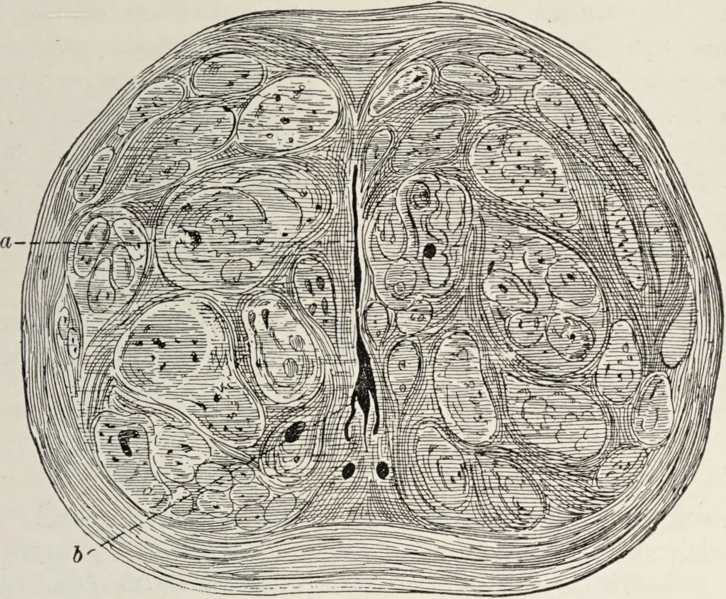 An illustration from A text-book of pathology / by Alfred Stengel ; with 394 illustrations in the text, many of them in colors, and 7 full-page chromolithographic plates., 1903, leaf 743