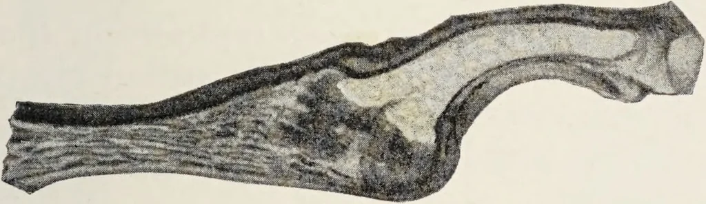 An illustration from A text-book of pathology / by Alfred Stengel ; with 394 illustrations in the text, many of them in colors, and 7 full-page chromolithographic plates., 1903, leaf 753