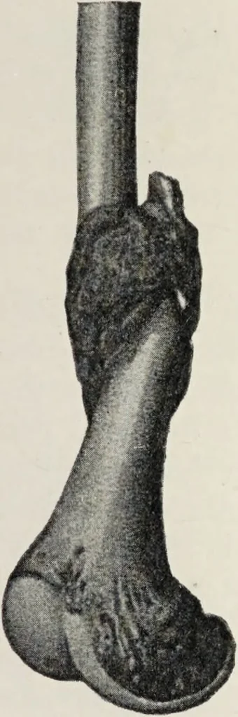 An illustration from A text-book of pathology / by Alfred Stengel ; with 394 illustrations in the text, many of them in colors, and 7 full-page chromolithographic plates., 1903, leaf 755