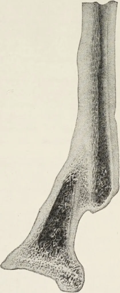 An illustration from A text-book of pathology / by Alfred Stengel ; with 394 illustrations in the text, many of them in colors, and 7 full-page chromolithographic plates., 1903, leaf 755