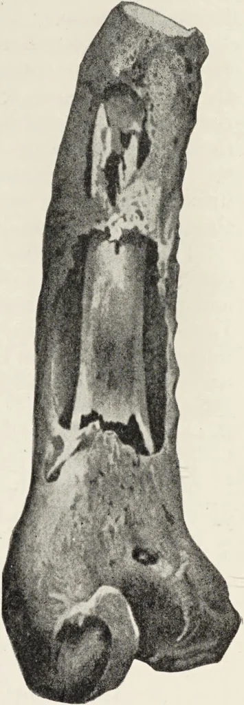 An illustration from A text-book of pathology / by Alfred Stengel ; with 394 illustrations in the text, many of them in colors, and 7 full-page chromolithographic plates., 1903, leaf 759