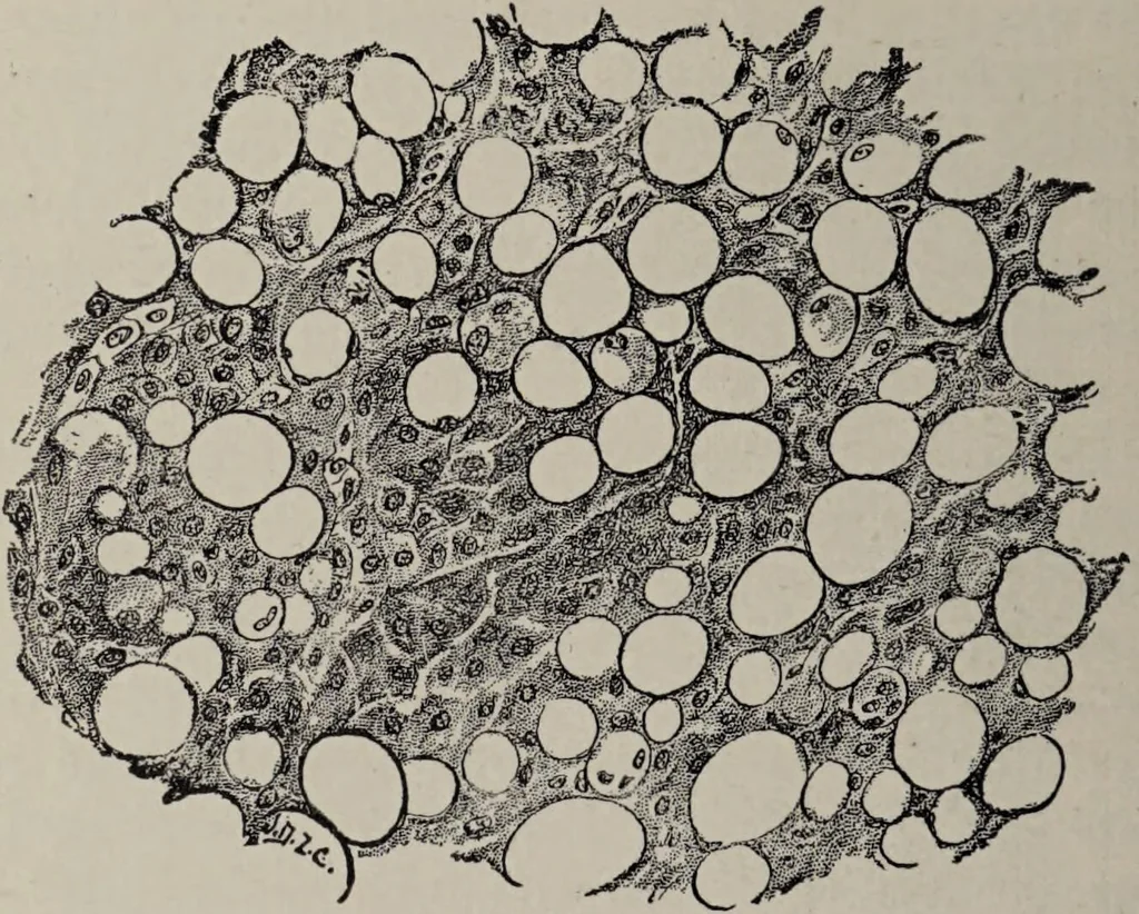 An illustration from A text-book of pathology / by Alfred Stengel ; with 394 illustrations in the text, many of them in colors, and 7 full-page chromolithographic plates., 1903, leaf 76