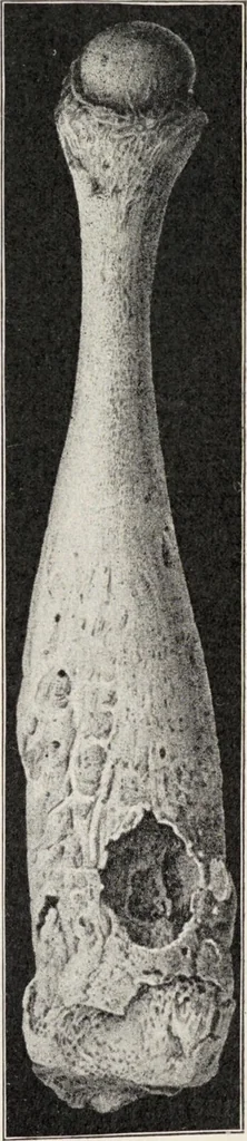 An illustration from A text-book of pathology / by Alfred Stengel ; with 394 illustrations in the text, many of them in colors, and 7 full-page chromolithographic plates., 1903, leaf 765