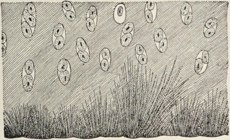 An illustration from A text-book of pathology / by Alfred Stengel ; with 394 illustrations in the text, many of them in colors, and 7 full-page chromolithographic plates., 1903, leaf 775
