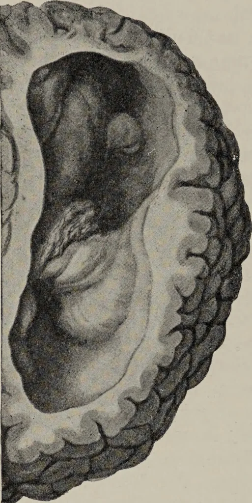 An illustration from A text-book of pathology / by Alfred Stengel ; with 394 illustrations in the text, many of them in colors, and 7 full-page chromolithographic plates., 1903, leaf 846