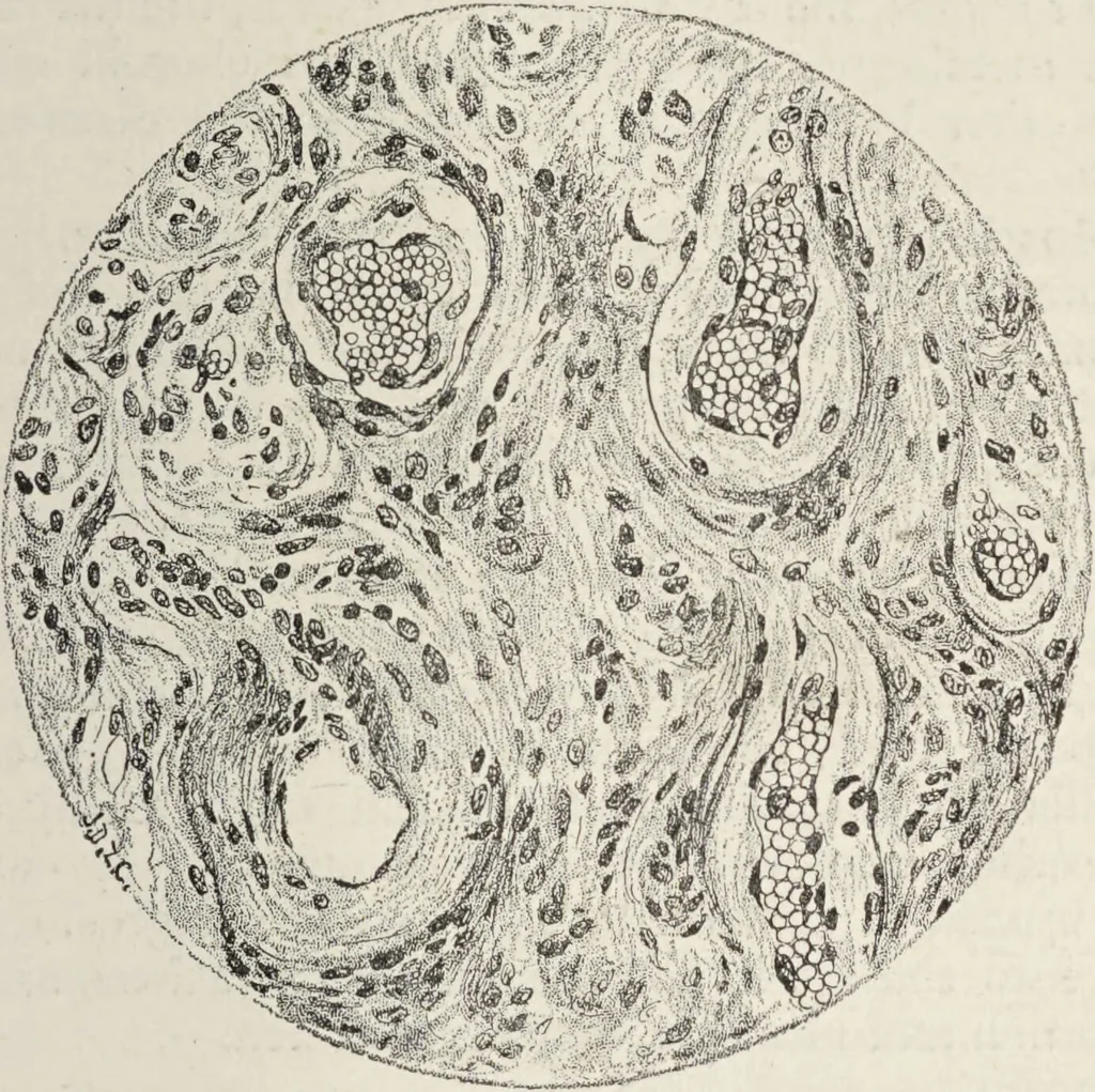 An illustration from A text-book of pathology / by Alfred Stengel ; with 394 illustrations in the text, many of them in colors, and 7 full-page chromolithographic plates., 1903, leaf 85