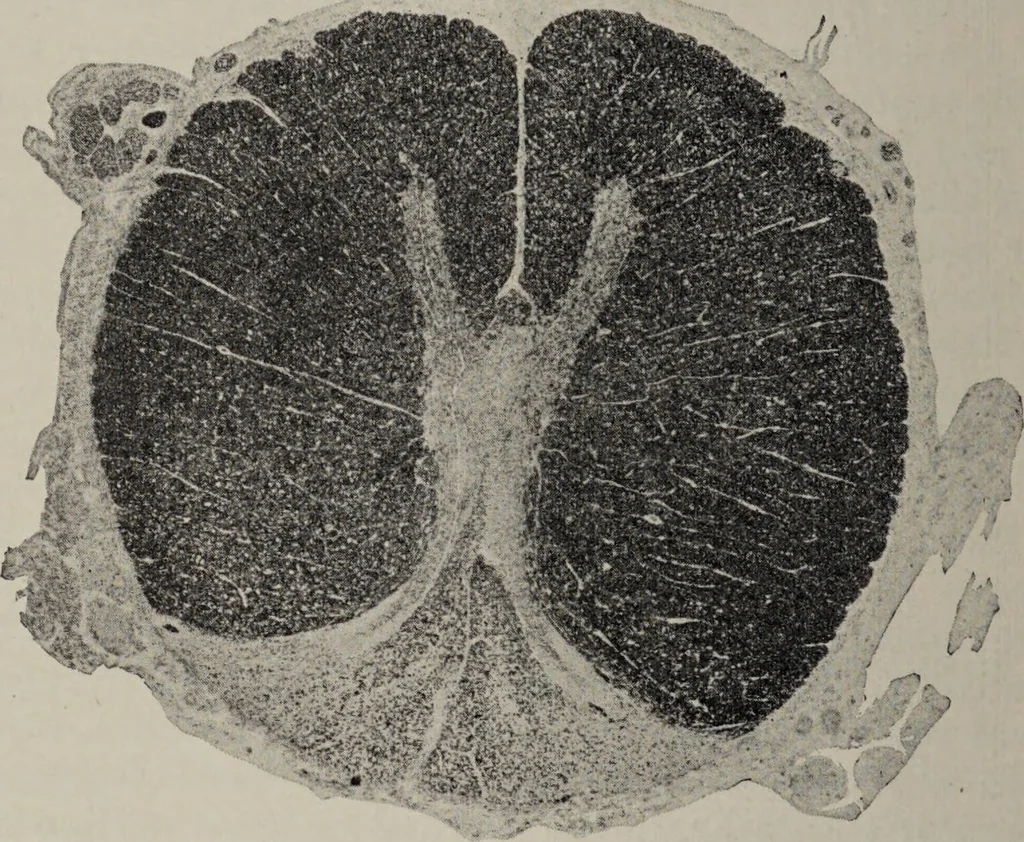 An illustration from A text-book of pathology / by Alfred Stengel ; with 394 illustrations in the text, many of them in colors, and 7 full-page chromolithographic plates., 1903, leaf 874