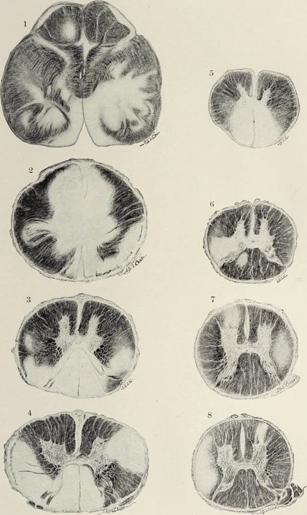 An illustration from A text-book of pathology / by Alfred Stengel ; with 394 illustrations in the text, many of them in colors, and 7 full-page chromolithographic plates., 1903, leaf 877