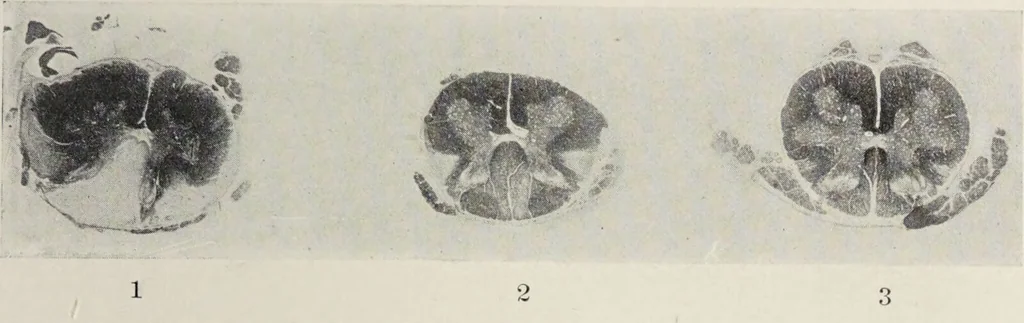 An illustration from A text-book of pathology / by Alfred Stengel ; with 394 illustrations in the text, many of them in colors, and 7 full-page chromolithographic plates., 1903, leaf 883