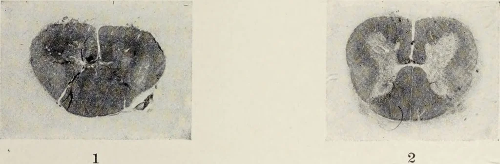An illustration from A text-book of pathology / by Alfred Stengel ; with 394 illustrations in the text, many of them in colors, and 7 full-page chromolithographic plates., 1903, leaf 883