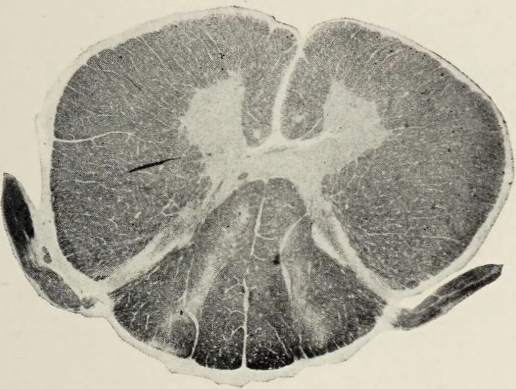An illustration from A text-book of pathology / by Alfred Stengel ; with 394 illustrations in the text, many of them in colors, and 7 full-page chromolithographic plates., 1903, leaf 885